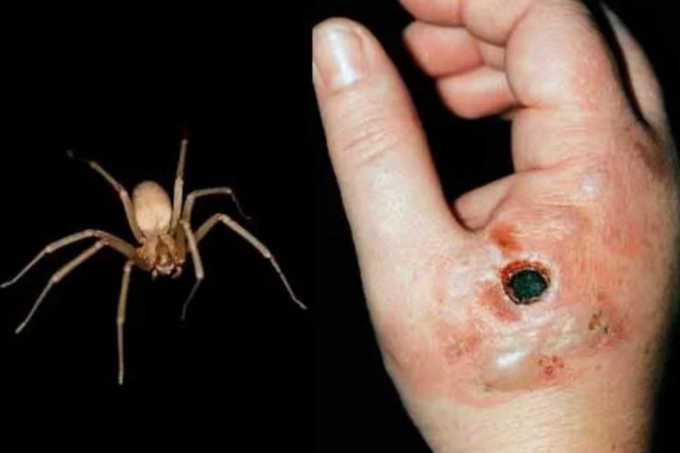 Come riconoscere il morso del ragno violino